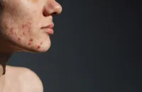 繰り返す顎ニキビを治す!おすすめの市販薬と処方薬を紹介