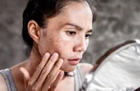 そのシミ、もしかしてビタミン不足?ピドキサールで始める美白習慣