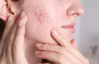 クリンダマイシンゲル（ダラシンTゲル）を正しく使うには？ニキビ治療・市販薬・注意点を徹底解説
