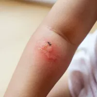 蚊に刺された部分が腫れる『スキーター症候群』の症状、原因、治療法まとめ