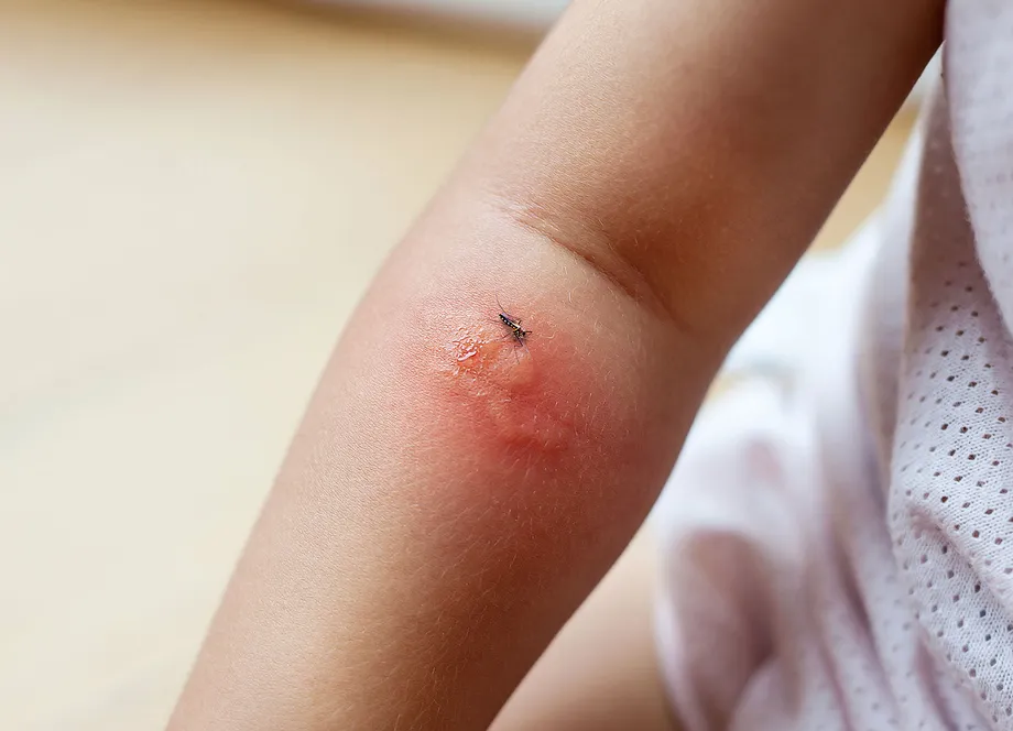 蚊に刺された部分が腫れる『スキーター症候群』の症状、原因、治療法まとめ