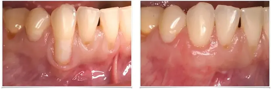 慢性歯周炎の治療