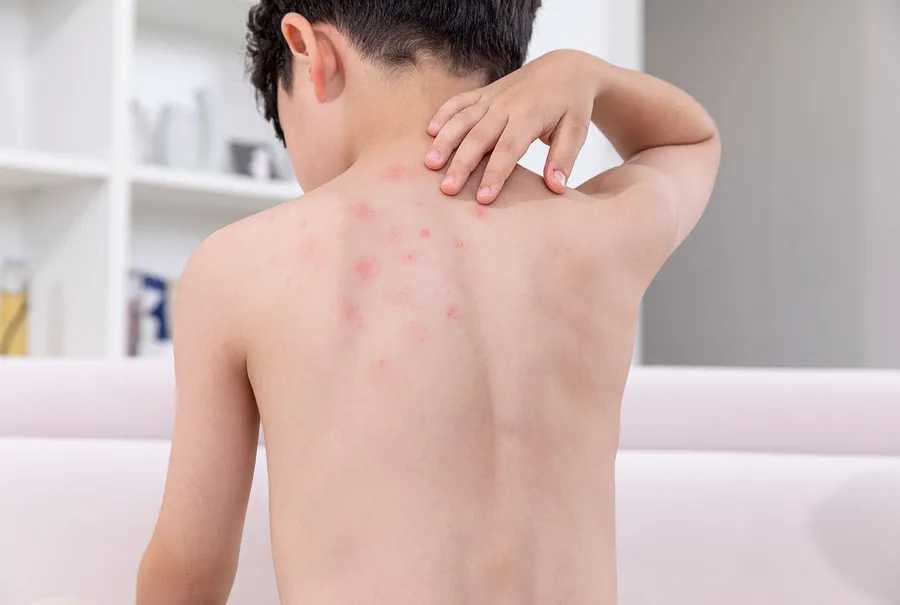 皮膚発疹の症状