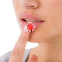 「口唇ヘルペスも性病ですか?」口唇ヘルペスの原因、症状、感染、治療法について