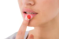 「口唇ヘルペスも性病ですか?」口唇ヘルペスの原因、症状、感染、治療法について