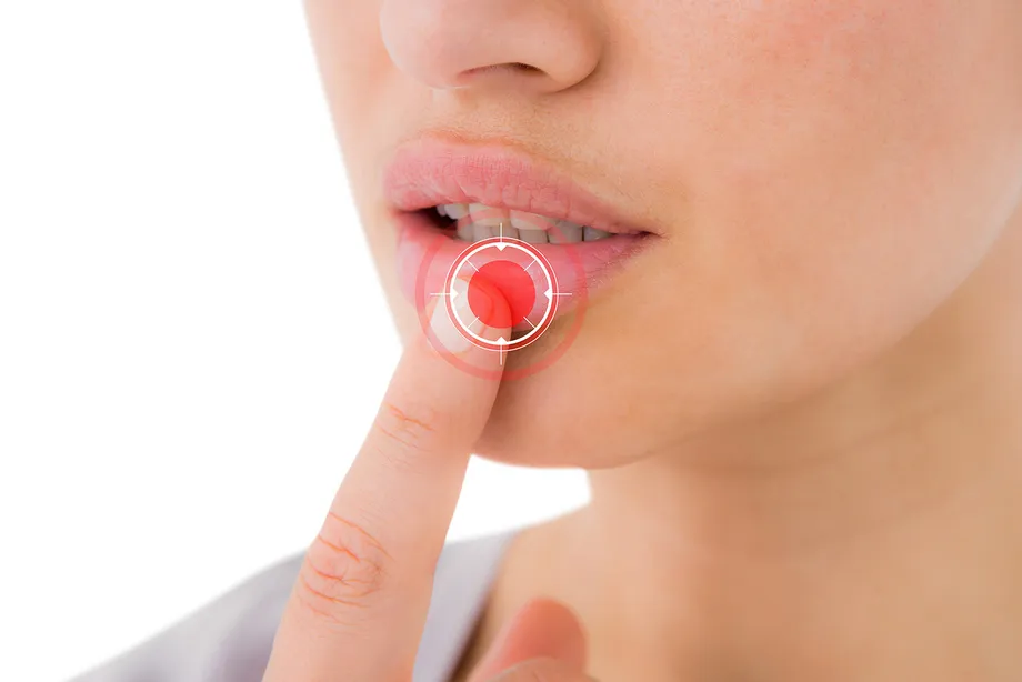 「口唇ヘルペスも性病ですか?」口唇ヘルペスの原因、症状、感染、治療法について