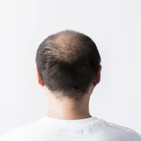 プロペシア?アボダード?どんな脱毛症治療薬を服用したらいいの?種類や副作用まで全部解説
