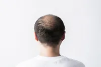 プロペシア?アボダード?どんな脱毛症治療薬を服用したらいいの?種類や副作用まで全部解説