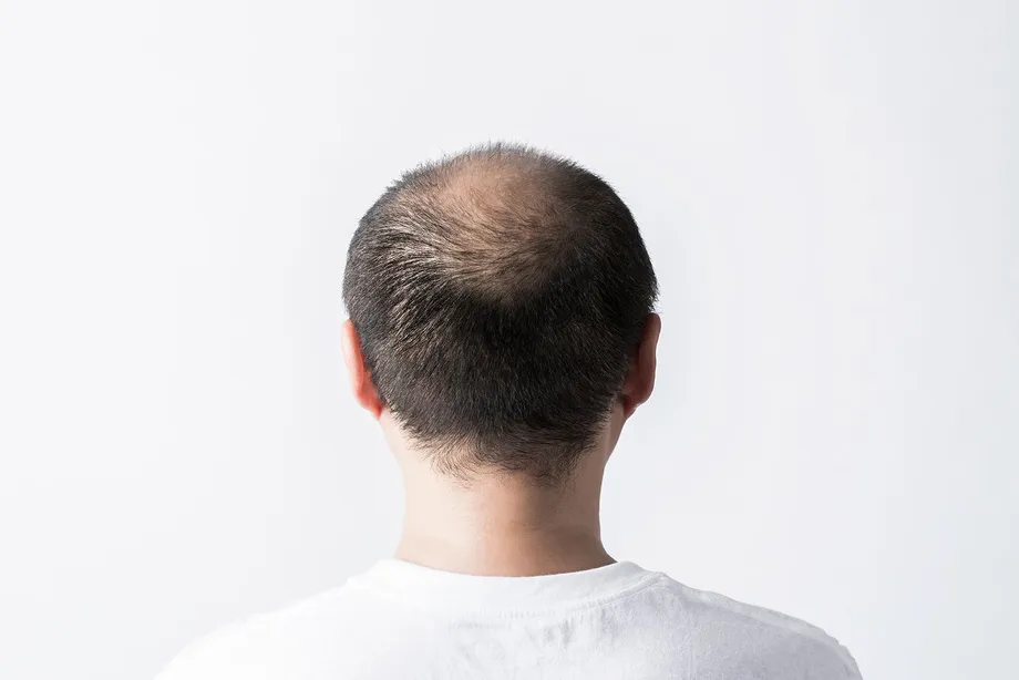 プロペシア?アボダード?どんな脱毛症治療薬を服用したらいいの?種類や副作用まで全部解説