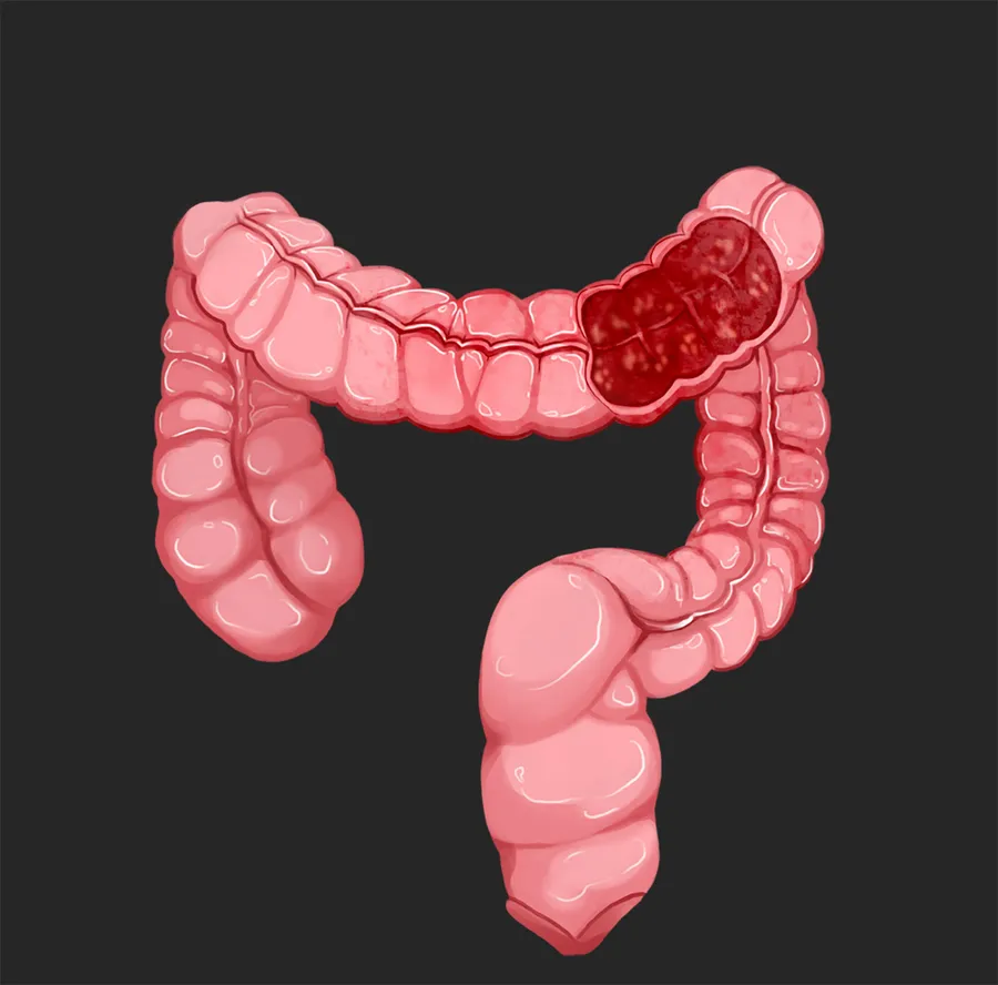 クローン病の症状