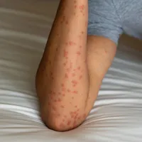 「エムポックス」の原因や症状、治療法は?