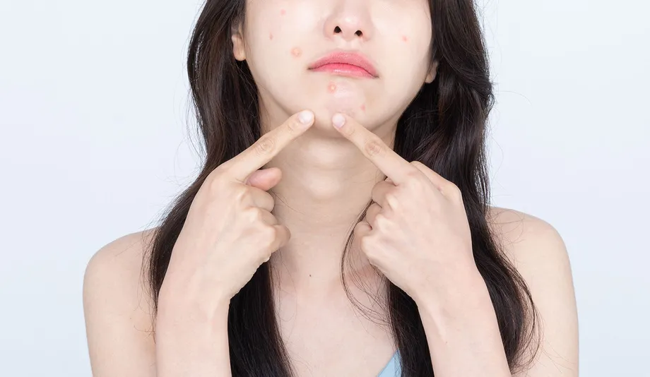 「ニキビ跡を消したい!」ニキビ跡の治療法について