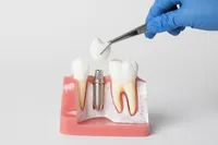 インプラントの種類、よくある質問についてまとめて解説します