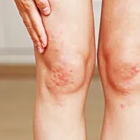 肌の乾燥や角質がひどい場合は、皮膚乾癬が疑われます。皮膚乾癬の症状、原因、治療法まとめ