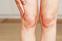 肌の乾燥や角質がひどい場合は、皮膚乾癬が疑われます。皮膚乾癬の症状、原因、治療法まとめ