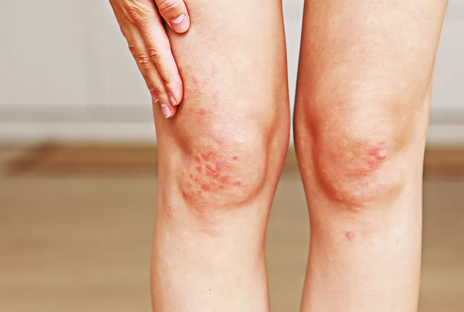 肌の乾燥や角質がひどい場合は、皮膚乾癬が疑われます。皮膚乾癬の症状、原因、治療法まとめ