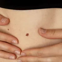 ほくろ?皮膚がん?皮膚がんの症状や識別方法を徹底解説