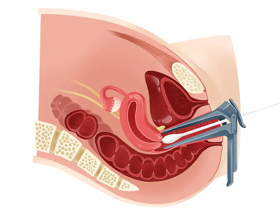 子宮頸がんの症状