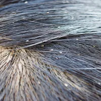 脂漏性皮膚炎、完治するのでしょうか?脂漏性皮膚炎の症状、原因、治療法まとめ