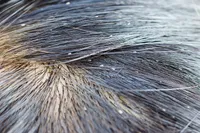 脂漏性皮膚炎、完治するのでしょうか?脂漏性皮膚炎の症状、原因、治療法まとめ