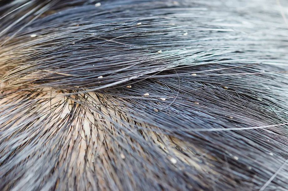 脂漏性皮膚炎、完治するのでしょうか?脂漏性皮膚炎の症状、原因、治療法まとめ