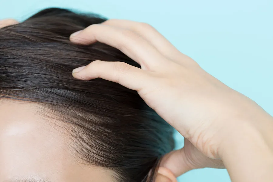 脂漏性皮膚炎の原因