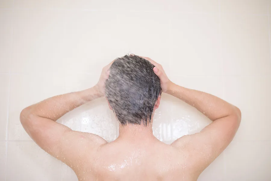 脂漏性皮膚炎の治療