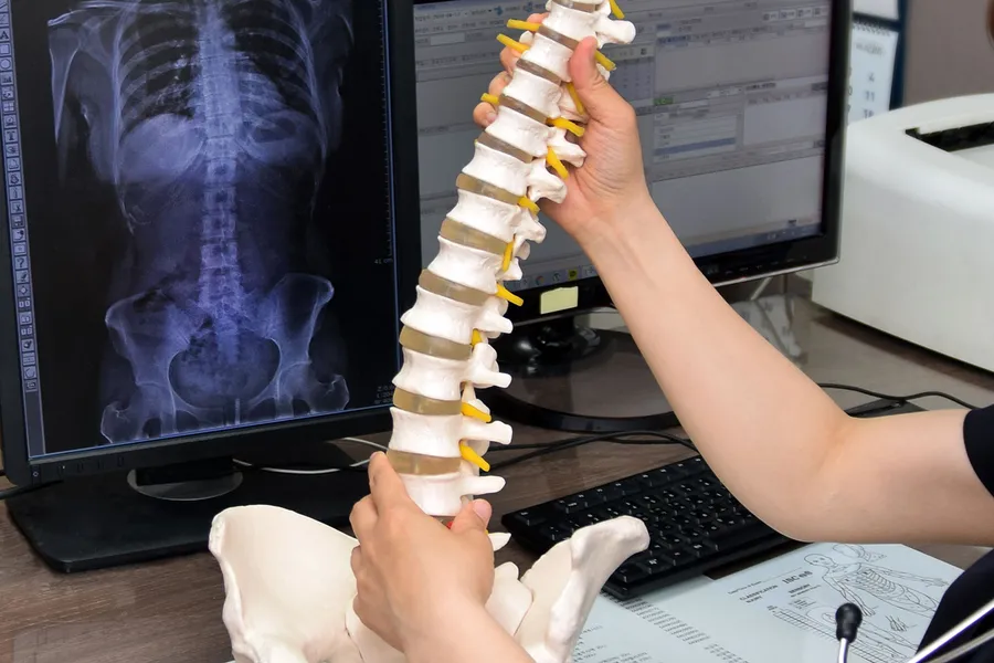 脊柱側弯症の原因