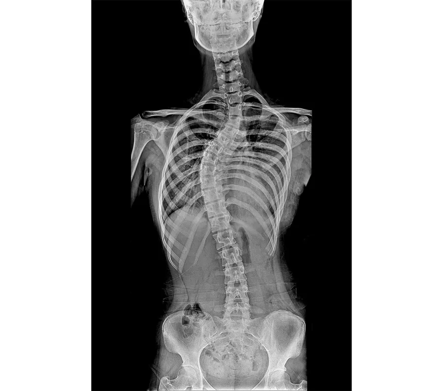 脊柱側弯症の治療