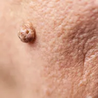 「ごつごつした」イボの除去方法とイボの種類、原因、症状、扁平疣贅について