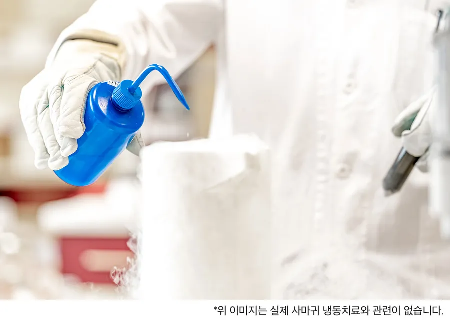 尋常性疣贅の凍結療法