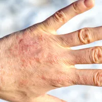 再発率の高い湿疹、湿疹の症状と原因&治療法を詳しく見てみましょう