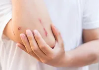 錆びた鉄に引っかかって傷ができました。破傷風になる可能性はどのぐらいですか? 破傷風の初期症状や治療法をお伝えします。