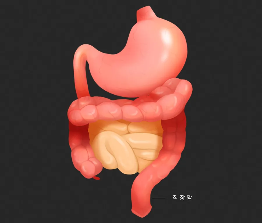 直腸がんの原因