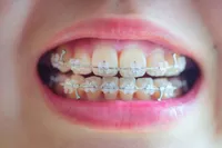 「歯列矯正の期間が気になります」歯列矯正に関するよくある質問にお答えします