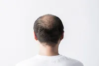 性欲が強いとハゲになるってホント?