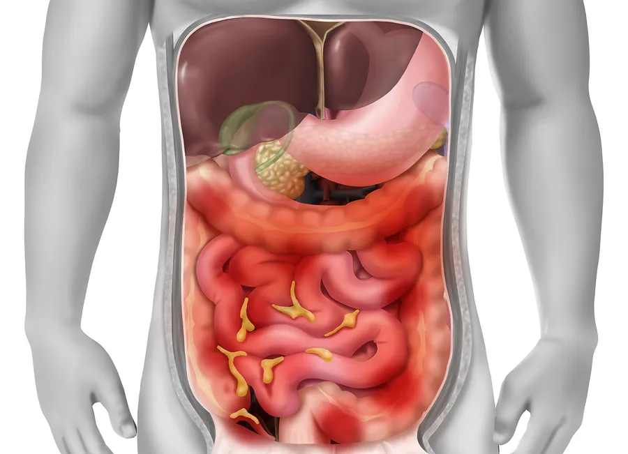 腹膜炎の症状