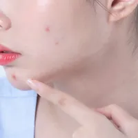 ニキビ治療薬と一緒に飲んではいけない薬まとめ