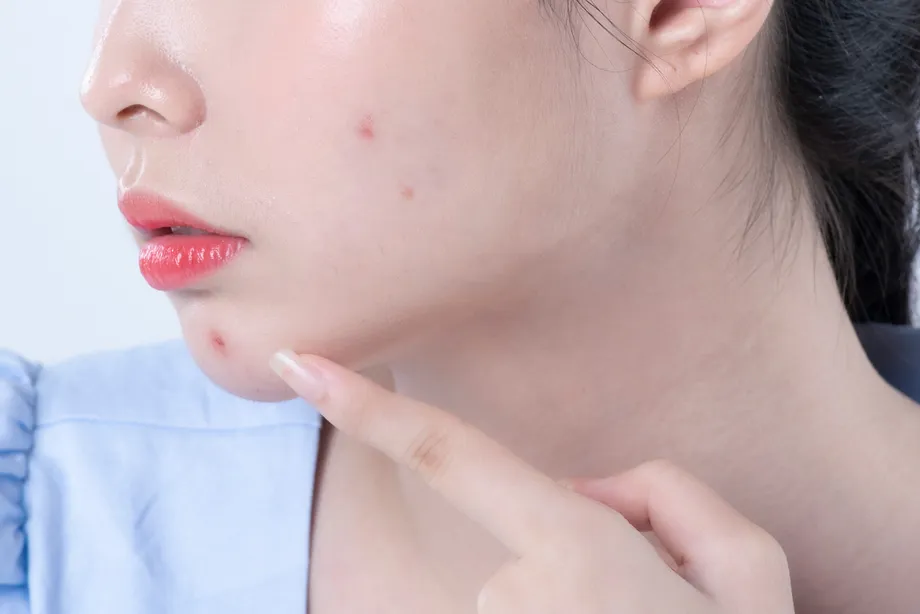 ニキビ治療薬と一緒に飲んではいけない薬まとめ