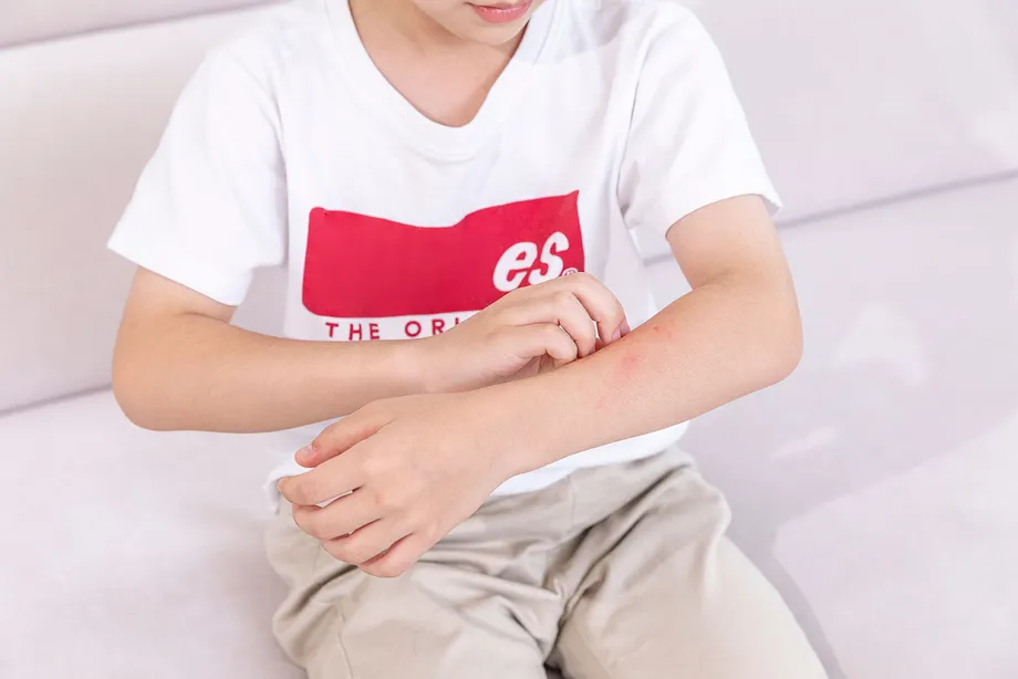 夏にかかりやすい『乳幼児の膿痂疹(とびひ)』原因や感染性、症状、治療法について