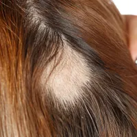 「脱毛サプリメントは効果がありますか?」薄毛の方におすすめのサプリメント、効能、服用方法について