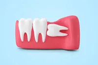 歯茎の中に埋まっている親知らず、抜くべきでしょうか?親知らずの抜歯、痛みについて