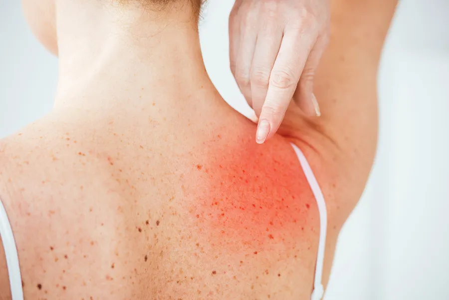 帯状疱疹感染性