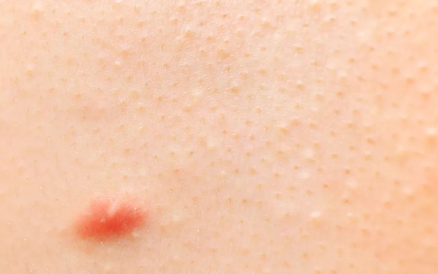 毛孔角化症治療