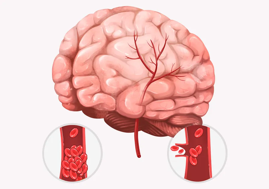 脳卒中の前兆症状