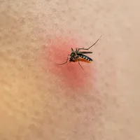 「マラリア」症状、蚊、予防薬、ワクチン、治療法について見てみましょう。