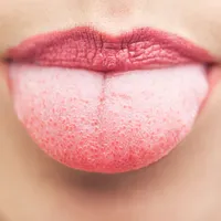 下にできる口内炎「舌炎」の原因や症状、早く治す方法は?