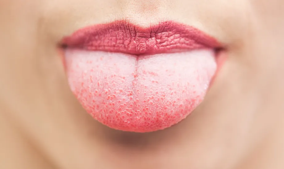 下にできる口内炎「舌炎」の原因や症状、早く治す方法は?