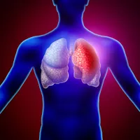 肺から空気が漏れる「気胸」の症状や原因、手術法を解説