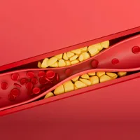 血中の脂質が増える「脂質異常症」の治療法、症状、原因、診断基準について詳しく解説します